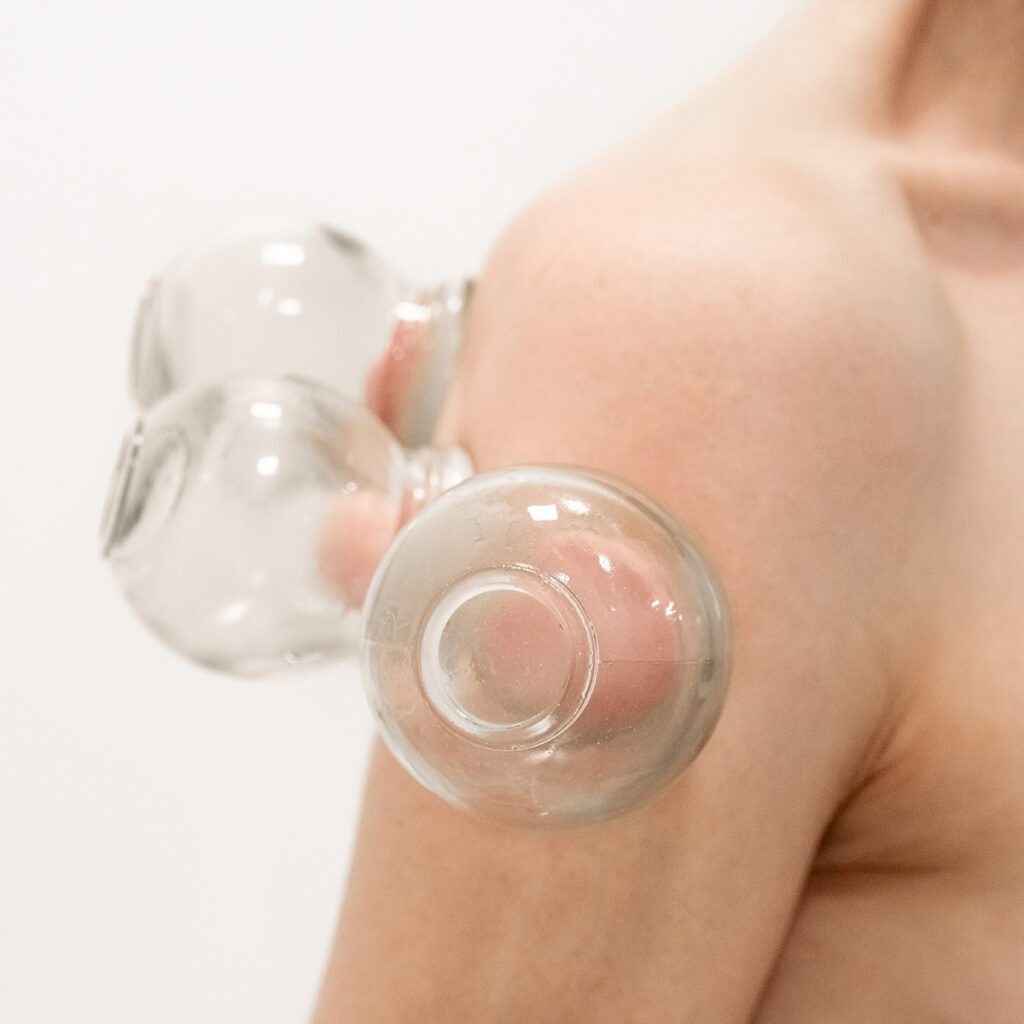 Gua Sha Schröpfen Moxibustion